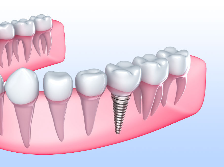 dental implant procedure