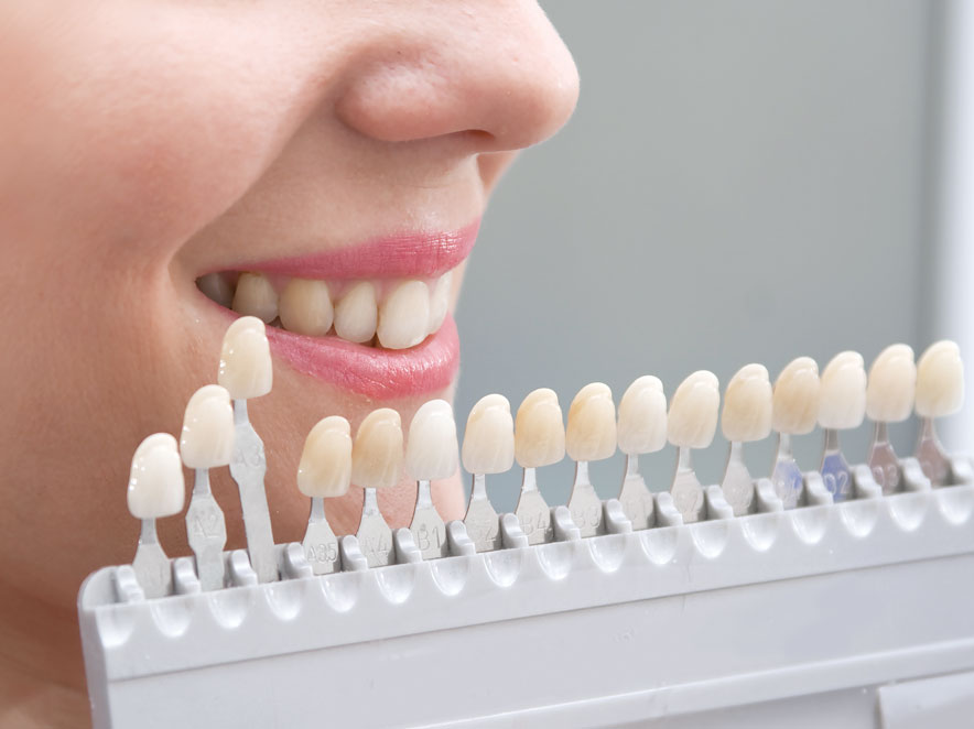 Dental veneers