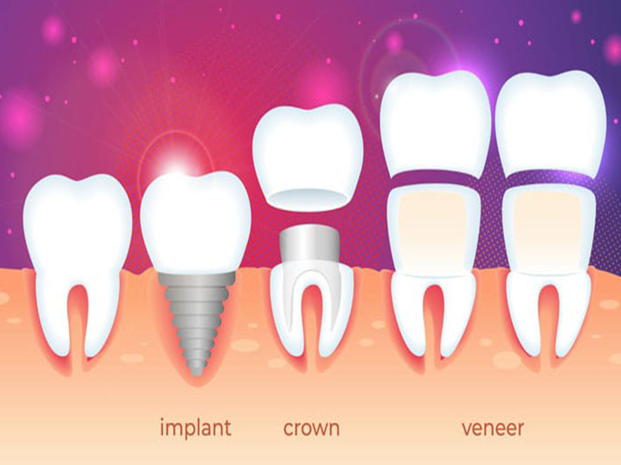 Dental Implants Melbourne Dental Implants Melbourne