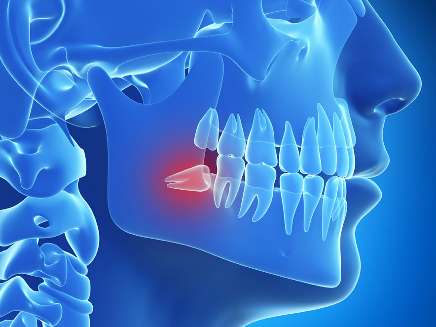 What happens in wisdom tooth surgery? What happens in wisdom tooth surgery?