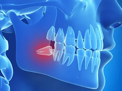 Wisdom Tooth Pain