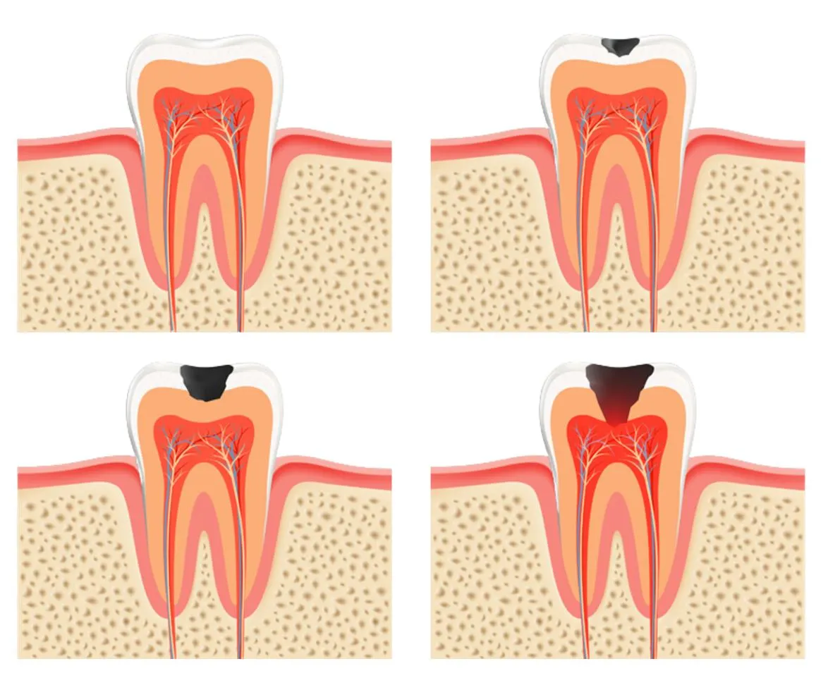 Stages of tooth decay tooth cavity stage