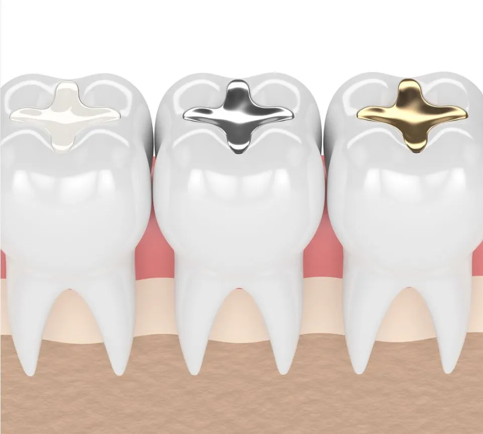 tooth filling cost Melbourne tooth filling cost Melbourne