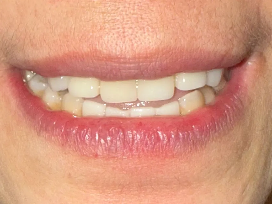 Reclaiming your smile: One step at a time