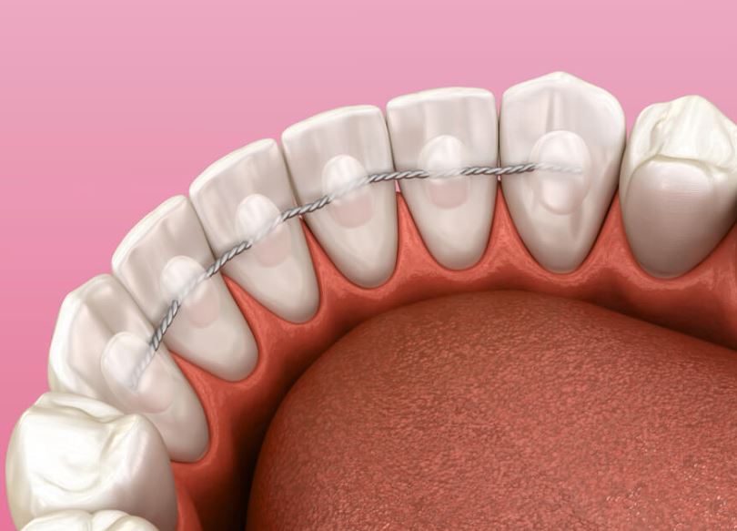 Fixed teeth retainer - permanent