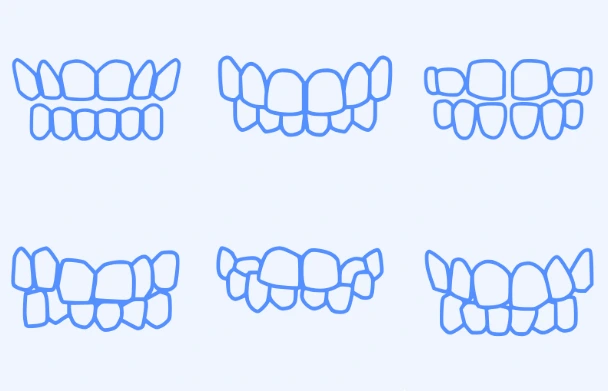 misaligned teeth that Suresmile can fix