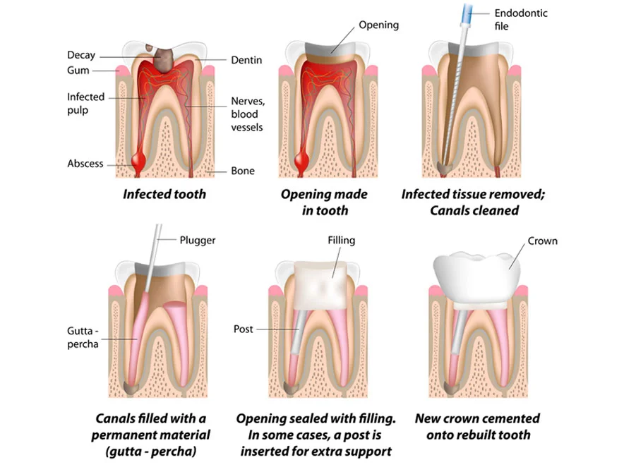 root canal procedure
