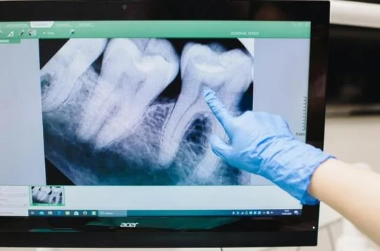 X-ray before root canal