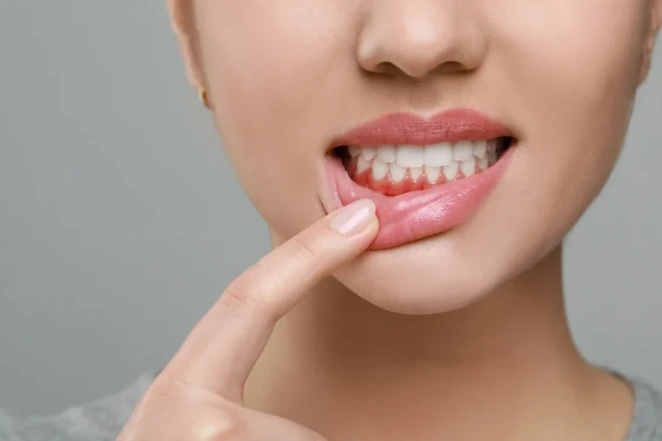 red gums, gingivitis