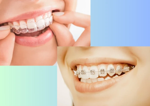 aligners or braces
