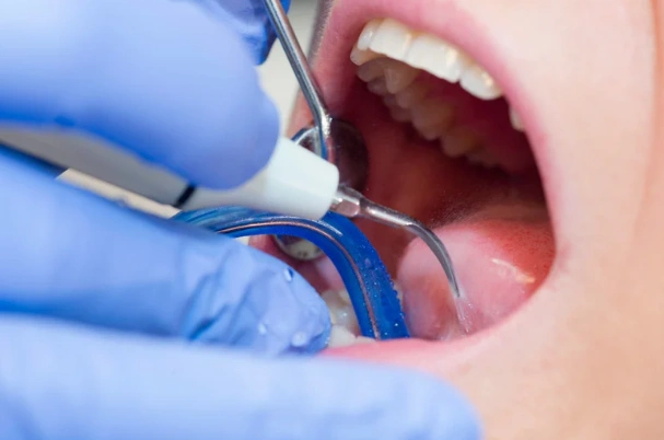 How do dentists remove tartar
