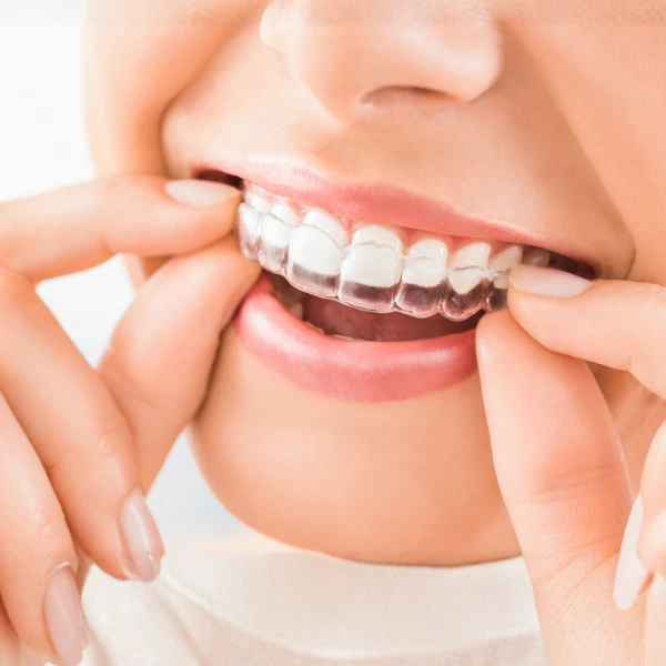 Invisible Aligners