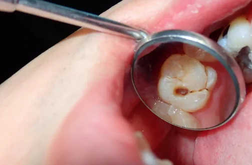 what does a dental cavity look like