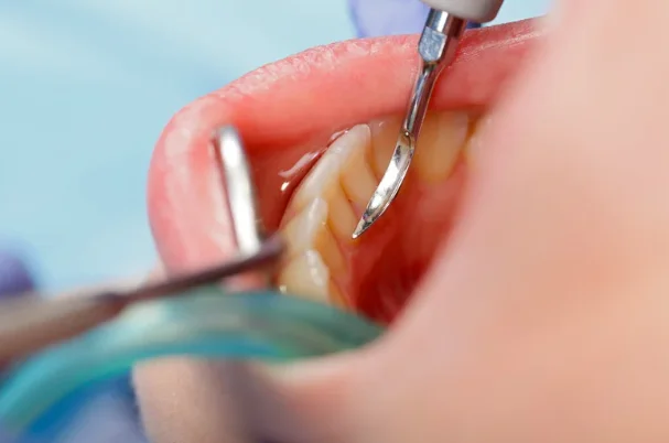 what is a dental cavity