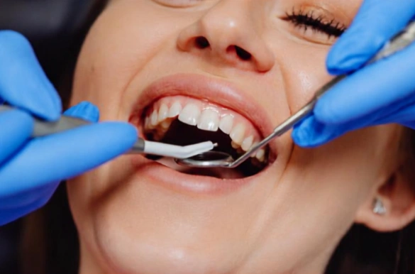what is dental plaque