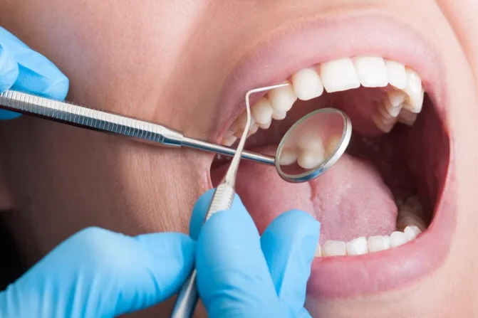 Where do cavities usually form?